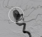 Angiografia digital projeção perfil. O círculo indica o volumoso aneurisma cerebral.