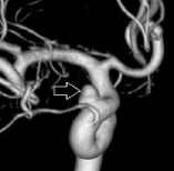Angiografia digital reconstrução 3D mostrando o aneurisma cerebral.