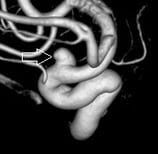 Angiografia digital 3D. A seta indica o aneurisma cerebral.