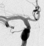 Angiografia digital projeção frontal após a cirurgia no cérebro e clipagem do aneurisma cerebral.