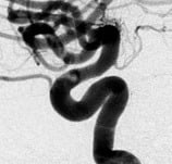 Angiografia digital projeção perfil após a cirurgia no cérebro e clipagem do aneurisma cerebral.