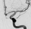 Angiografia digital projeção frontal após a cirurgia no cérebro e clipagem de aneurisma cerebral.