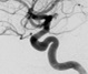 Angiografia digital projeção perfil após cirurgia no cérebro e clipagem do aneurisma cerebral.