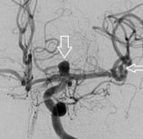 Angiografia digital projeção frontal. A seta indica o aneurisma cerebral.