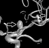 Angiografia digital 3D projeção perfil. A seta indica o aneurisma cerebral.