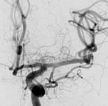 Angiografia digital projeção frontal após cirurgia no cérebro e clipagem do aneurisma cerebral. 
