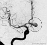 Angiografia projeção frontal mostrando o aneurisma cerebral.