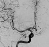 Angiografia projeção frontal após a cirurgia no cérebro para a clipagem do aneurisma cerebral.