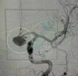 Angiografia projeção frontal mostrando o volumoso aneurisma cerebral.
