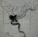 Angiografia digital projeção perfil mostrando 2 aneurismas cerebrais. 