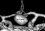 Reconstrução 3D da angiotomografia projeção frontal mostrando o volumoso aneurisma cerebral.