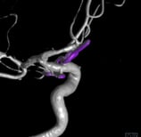 Reconstrução 3D da angiotomografia após a cirurgia no cérebro e clipagem do aneurisma cerebral.