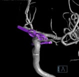 Reconstrução 3D da angiotomografia após a cirurgia no cérebro e clipagem do aneurisma cerebral.