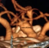 Reconstrução 3D da angiotomografia projeção frontal mostrando o volumoso aneurisma cerebral.