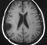 Ressonância magnética após a cirurgia mostrando a retirada total do meningeoma.