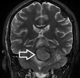Ressonância coronal mostrando volumoso cavernoma (seta) na ponte (tronco encefálico).