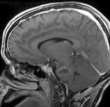 Ressonância corte sagital após a cirurgia no cérebro e remoção total do cavernoma.