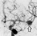 Angiografia digital projeção frontal. A seta indica o aneurisma cerebral.