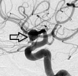 Angiografia digital projeção perfil. A seta indica o aneurisma cerebral.