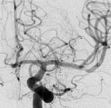 Angiografia digital projeção frontal após a cirurgia no cérebro e clipagem do aneurisma cerebral.