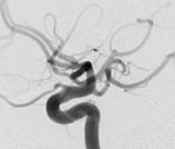 Angiografia digital projeção perfil após a cirurgia no cérebro e clipagem do aneurisma cerebral.
