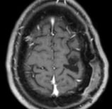 Ressonância após a cirurgia com a remoção total do tumor e paciente livre de epilepsia.