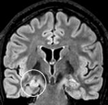 Ressonância de moça de 18 anos com epilepsia desde 12 anos. O círculo indica a esclerose hipocampal.