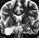 Ressonância após cirurgia no cérebro com remoção da amígdala e hipocampo. Ela ficou sem epilepsia.