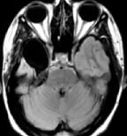 Ressonância após a cirurgia no cérebro com remoção da amígdala e hipocampo. Ela ficou sem epilepsia.