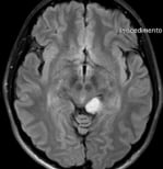 Ressonância de paciente com tumor temporal medial esquerdo antes da cirurgia no cérebro.
