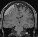 Ressonância de homem de 50 anos com volumoso hematoma subdural crônico fronto-parietal direito.
