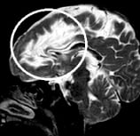 Ressonância de menina de 3 anos com epilepsia há 2 anos, sequela de abscesso cerebral (círculo).