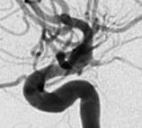 Angiografia digital perfil após a cirurgia no cérebro e clipagem do aneurisma cerebral.