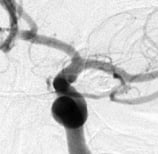 Angiografia digital perfil após a cirurgia no cérebro e clipagem do aneurisma cerebral.