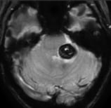Paciente com cavernoma e sangramento intracerebral antes de cirurgia no cérebro.