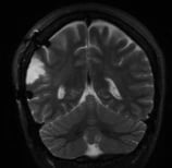 Ressonância após a retirada total do tumor. A paciente ficou livre de crises de epilepsia.