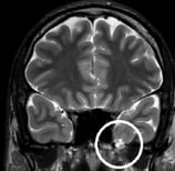 Ressonância de homem de 30 anos com epilepsia desde os 17 anos. Círculo indica encefalocele.
