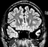 Ressonância após a cirurgia no cérebro com remoção da encefalocele. Ele ficou sem crises.