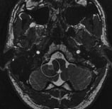 Ressonância magnética de um paciente com tumor no cerebelo antes da cirurgia.