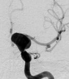 Angiografia digital projeção frontal mostrando um volumoso aneurisma cerebral.