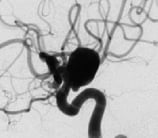Angiografia digital projeção perfil mostrando o mesmo aneurisma cerebral.