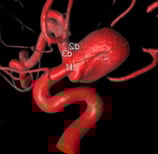 Angiografia digital 3D perfil mostrando o mesmo aneurisma cerebral.