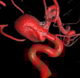 Angiografia digital 3D mostrando a face lateral do aneurisma cerebral.