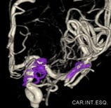 Angiografia digital 3D após a clipagem do aneurisma cerebral.