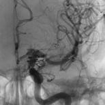 Angiografia após a cirurgia no cérebro e clipagem do aneurisma cerebral.