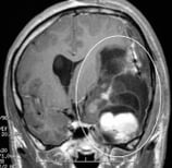 Ressonância de homem de 31 anos com epiepsia refratária e volumoso tumor cerebral.