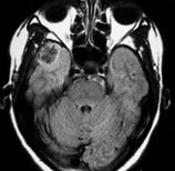 Ressonância de paciente epiléptica com tumor temporal direito antes da cirurgia no cérebro.