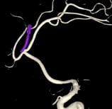 Angiografia digital 3D após a cirurgia no cérebro e clipagem do aneurisma cerebral (clipe em roxo).