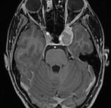 Ressonância de paciente com dor na testa e tumor no seio cavernoso antes da cirurgia no cérebro.