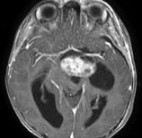 Ressonância de criança com cefaleia e volumoso tumor antes da cirurgia no cérebro.